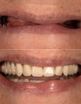 Smile Makeovers