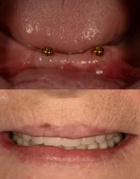 Permanent Implants