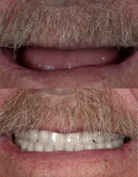 Smile Makeovers