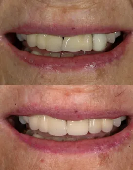 Snap on Dentures