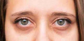 Tired of Looking Tired? Real Solutions for Dark Under-Eye Circles