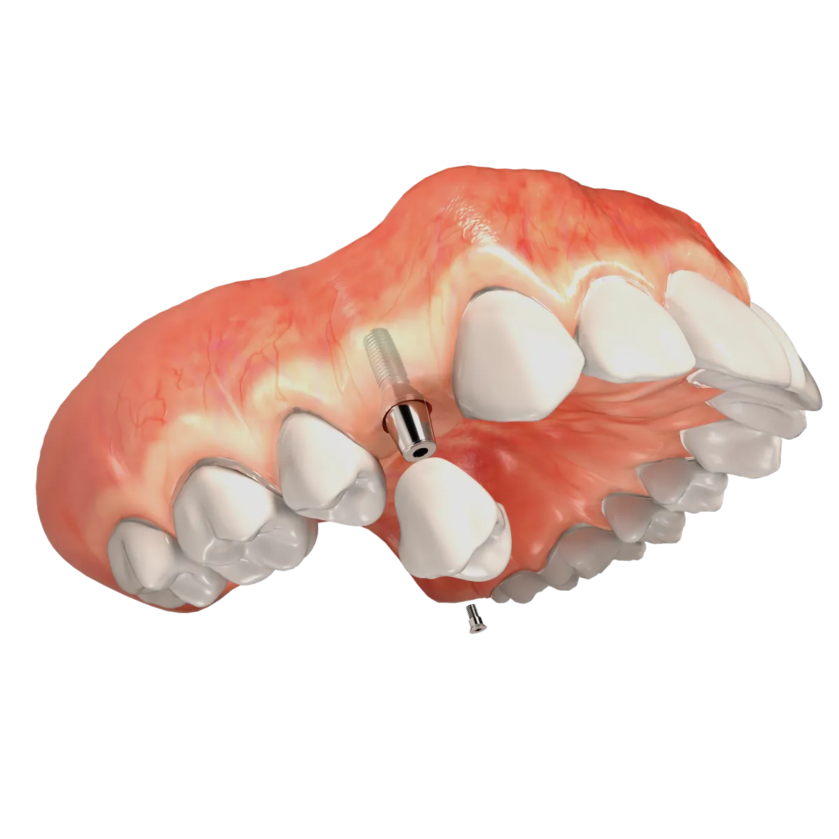 Dental Implants