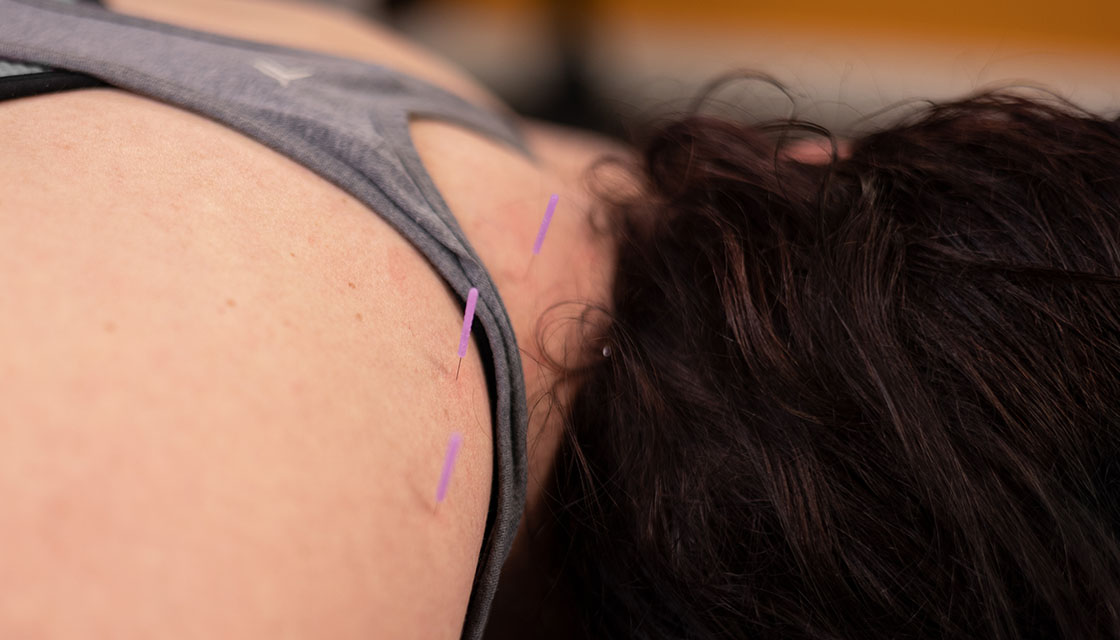 dry needling bismarck