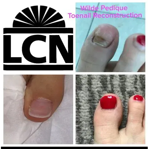 PROSTHETIC TOENAILS