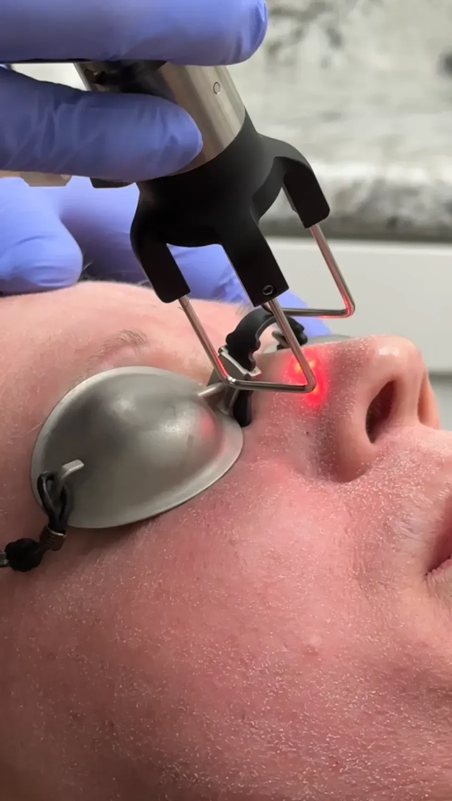 A patient receives CO2 cool peel treatment on her face. 