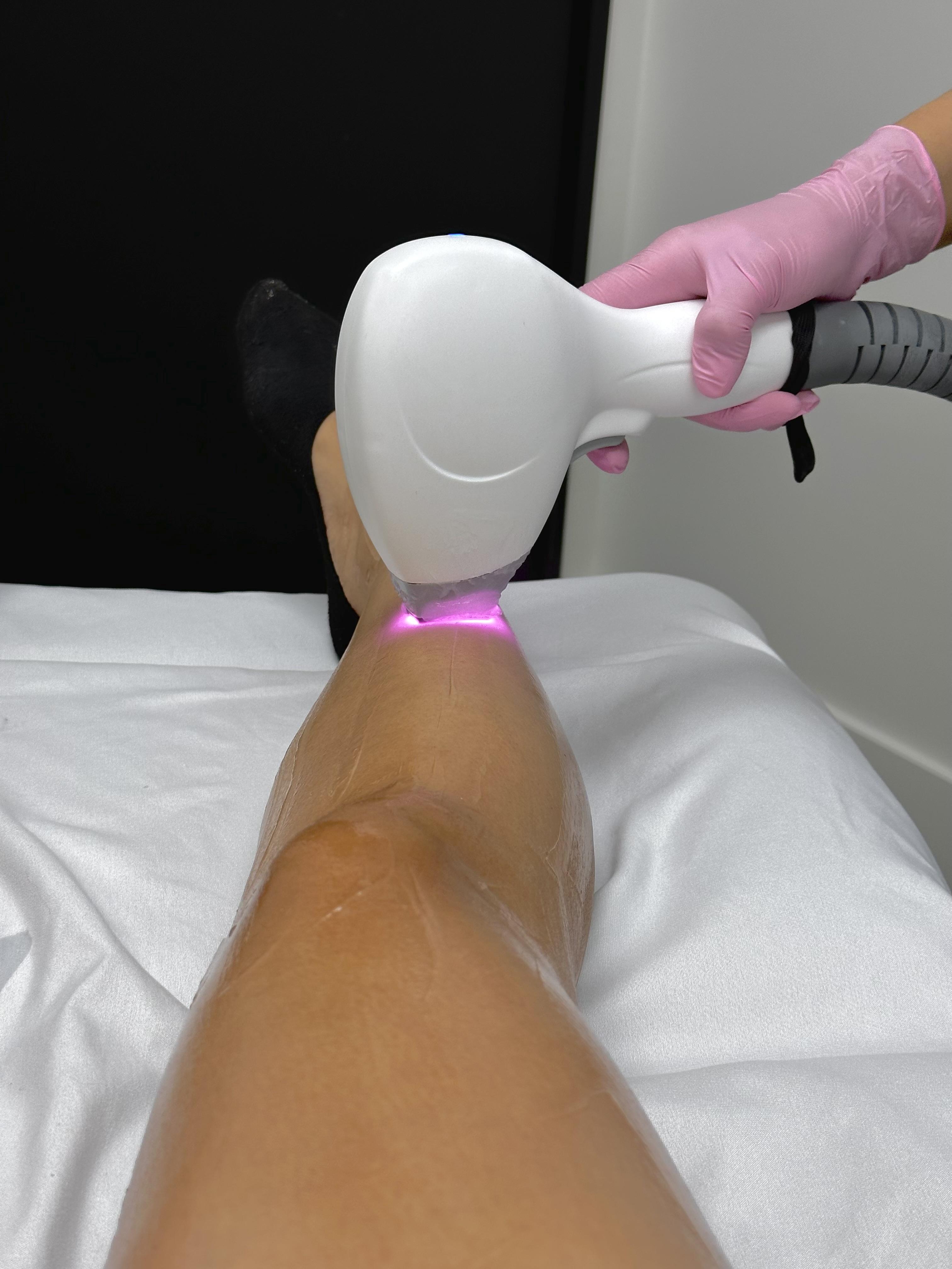 Laser Hair Removal Treatment on Legs