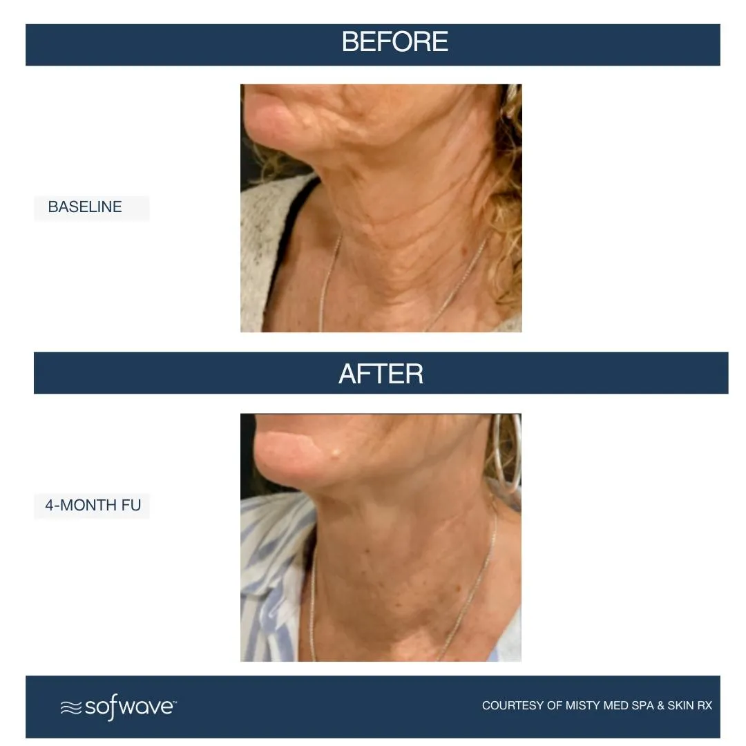 sofwave before and after results