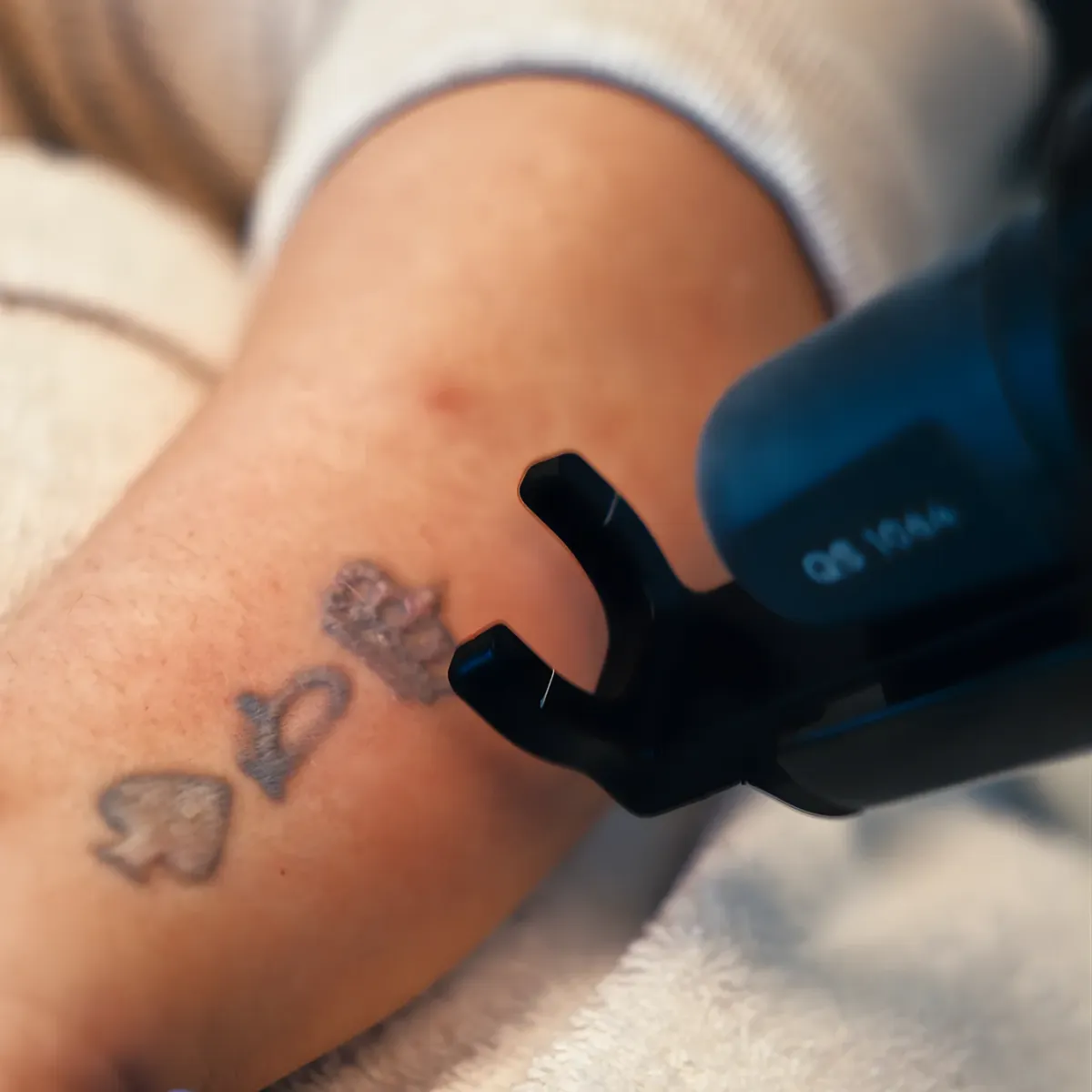 Laser Tattoo Removal Houston
