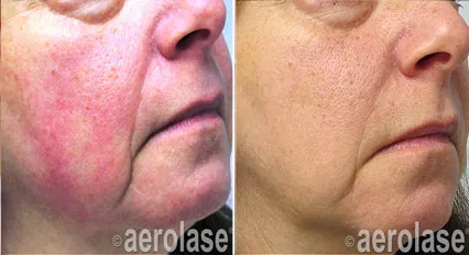 Aerolase Skin Treatments
