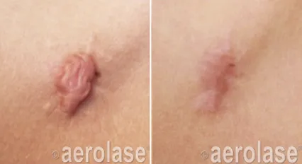 Aerolase Skin Treatments