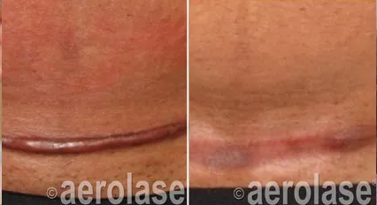 Aerolase Skin Treatments