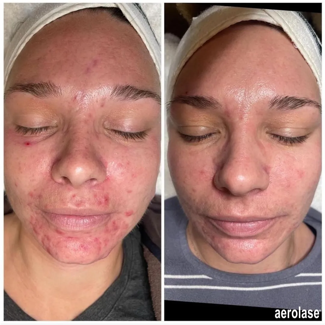Aerolase Skin Treatments