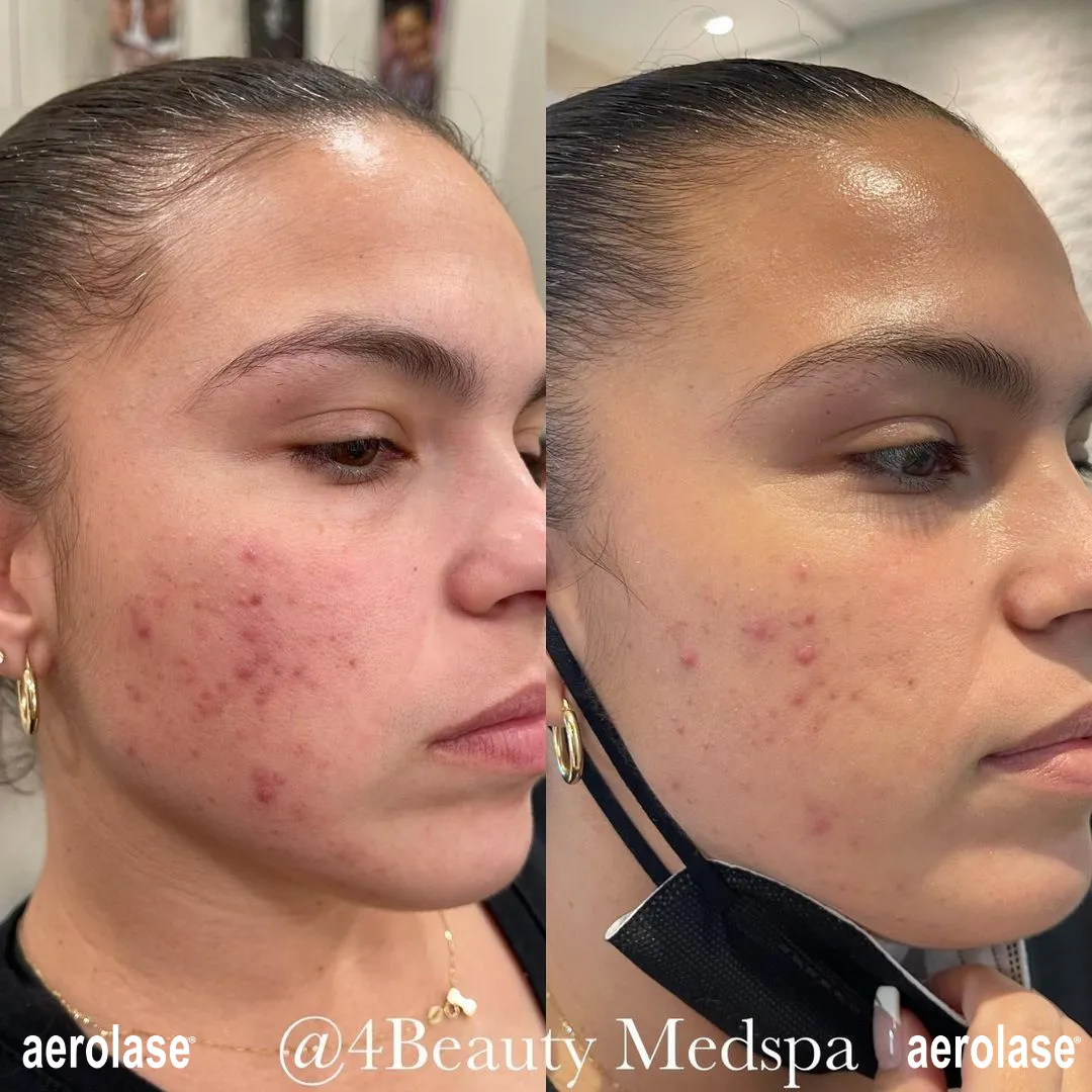 Aerolase Skin Treatments