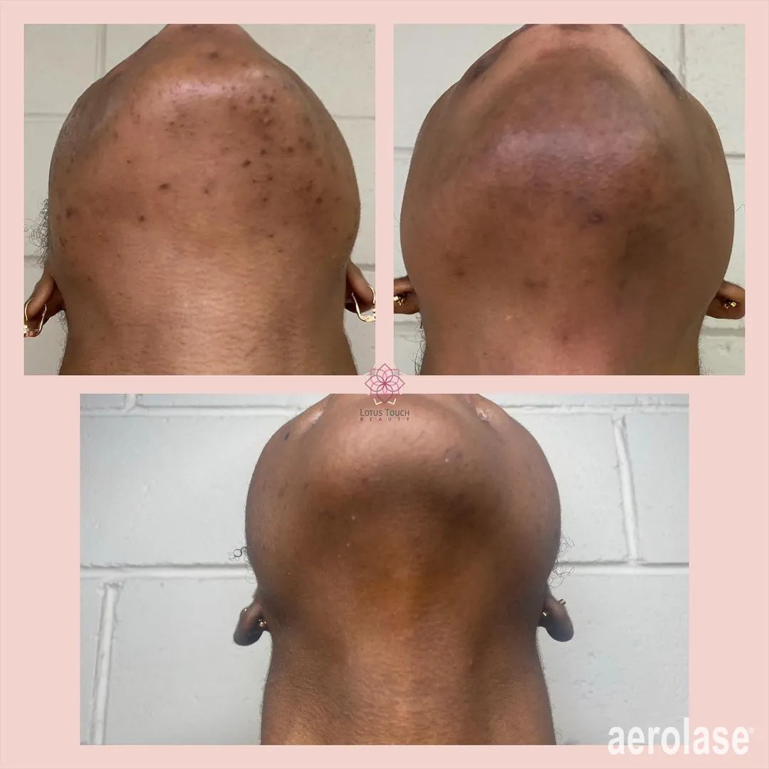 Aerolase Skin Treatments