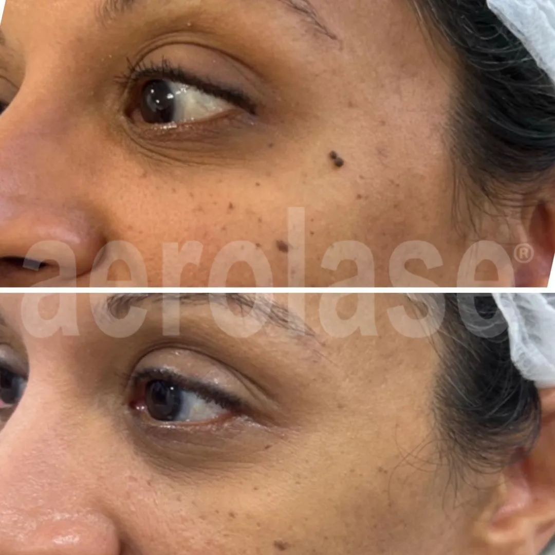 Aerolase Skin Treatments