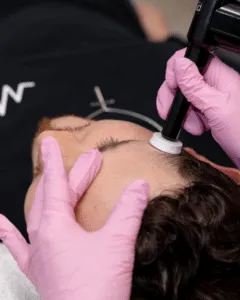 Close-up of a microchanneling procedure on a patient's cheek, showing a microneedling device creating fine micro-injuries to stimulate skin renewal and collagen production.
