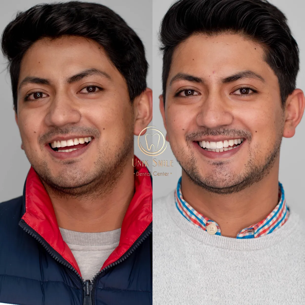 Resultado de paciente - Blefaroplastia