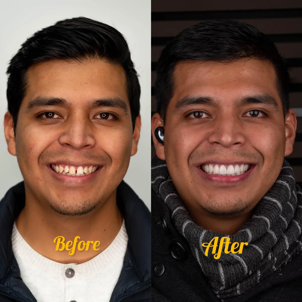 Resultado de paciente - Blefaroplastia