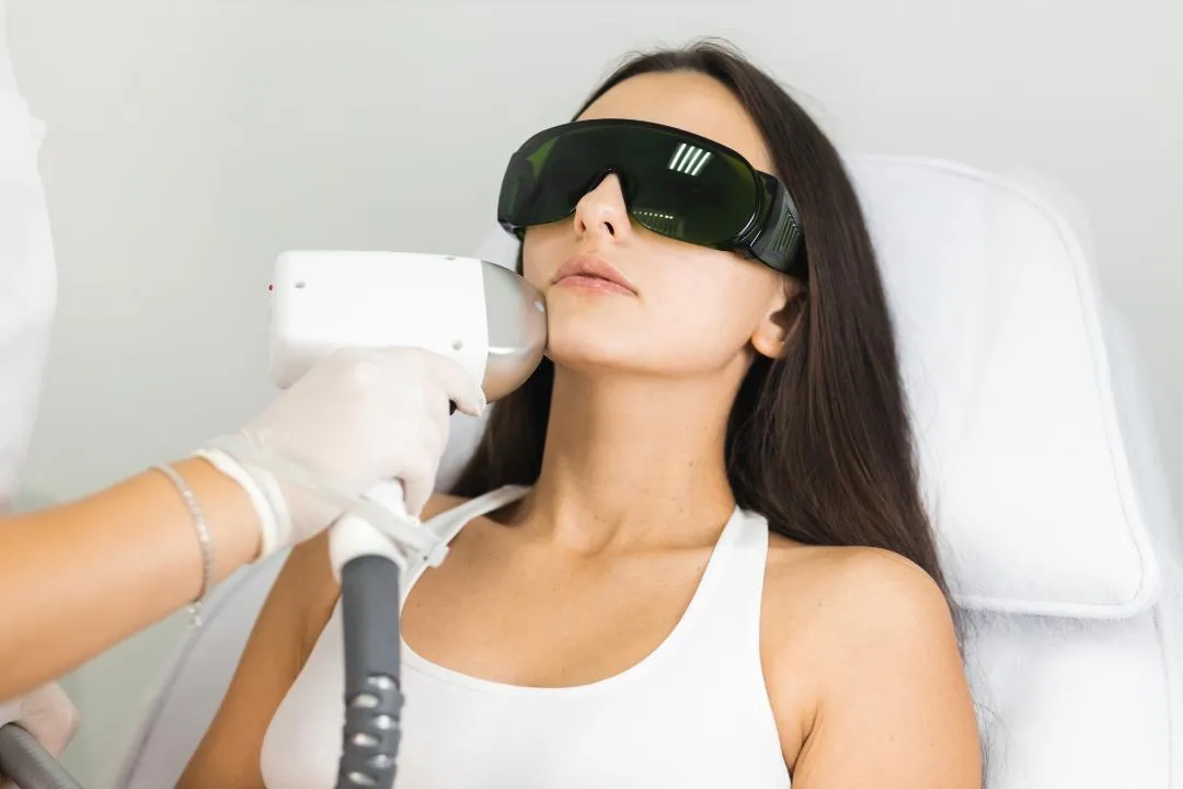 Woman receiving laser hair removal on upper lip while wearing protective glasses, illustrating precision treatment and gradual smooth skin results.