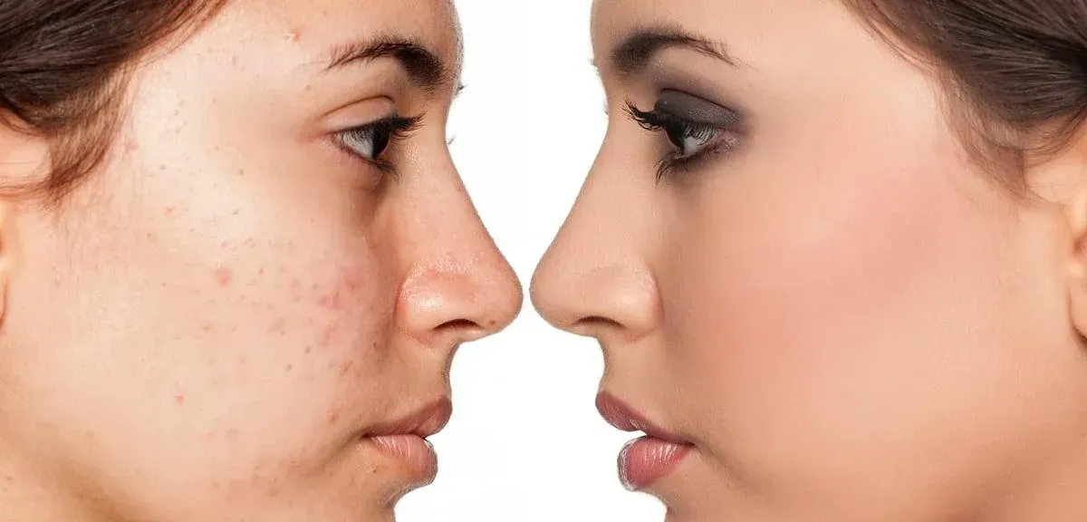 Acne Facial Treatment at LeVogue.