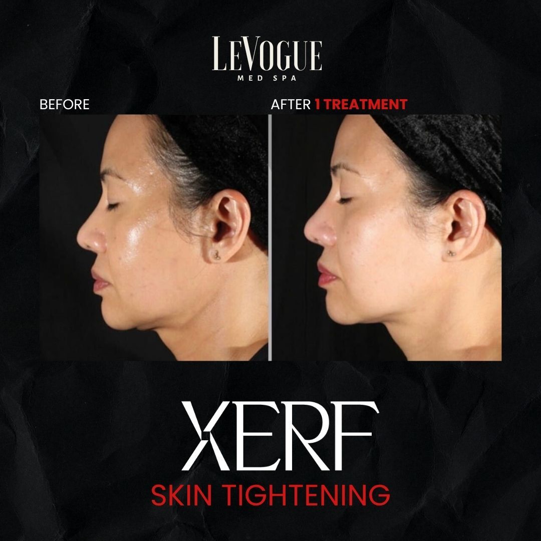 XERF RF skin tightening at LeVogue.
