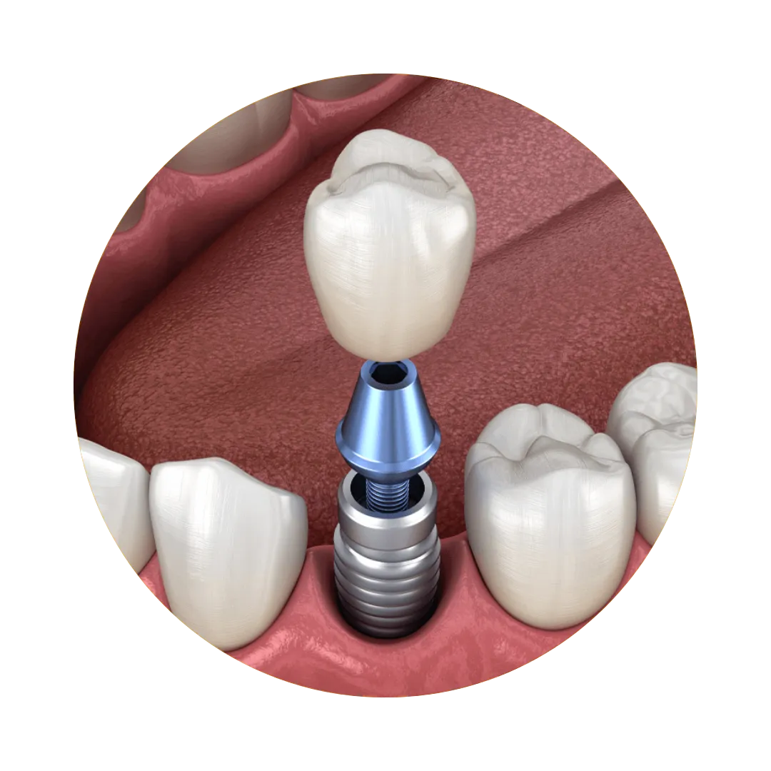 Single Dental Implant