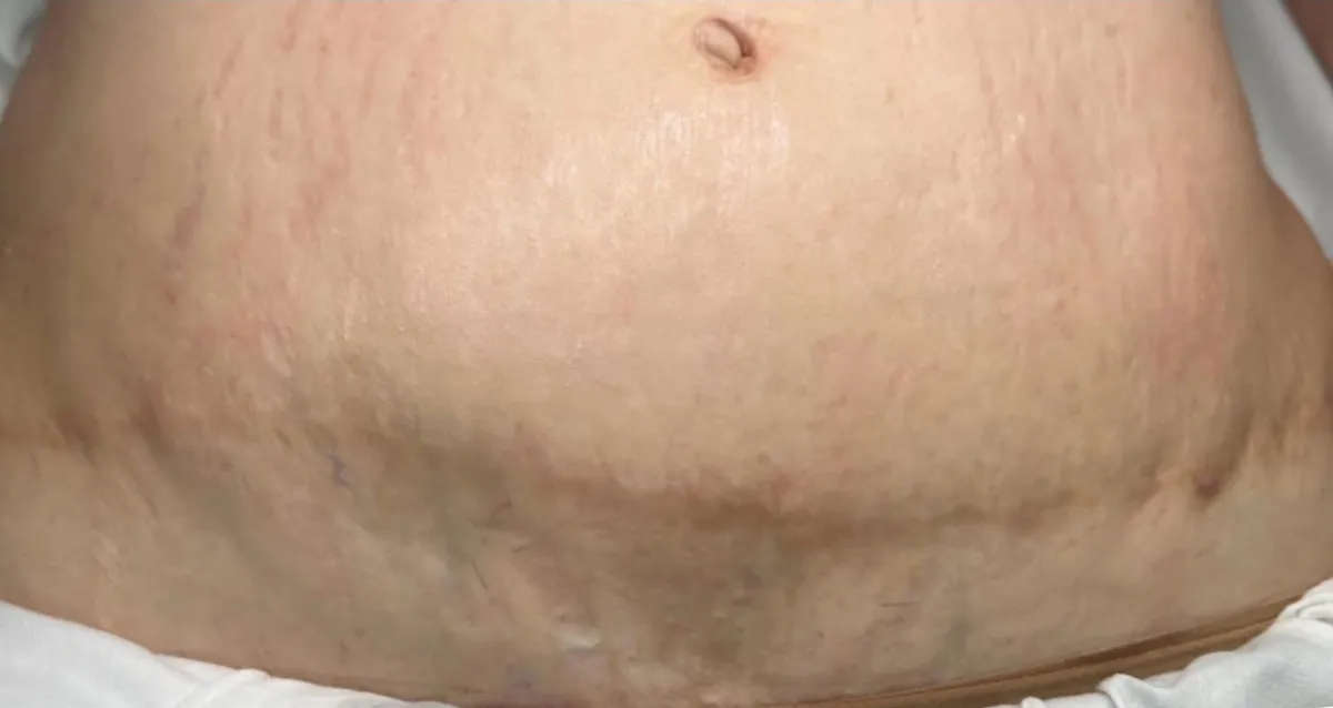 Stretch mark revision stomach