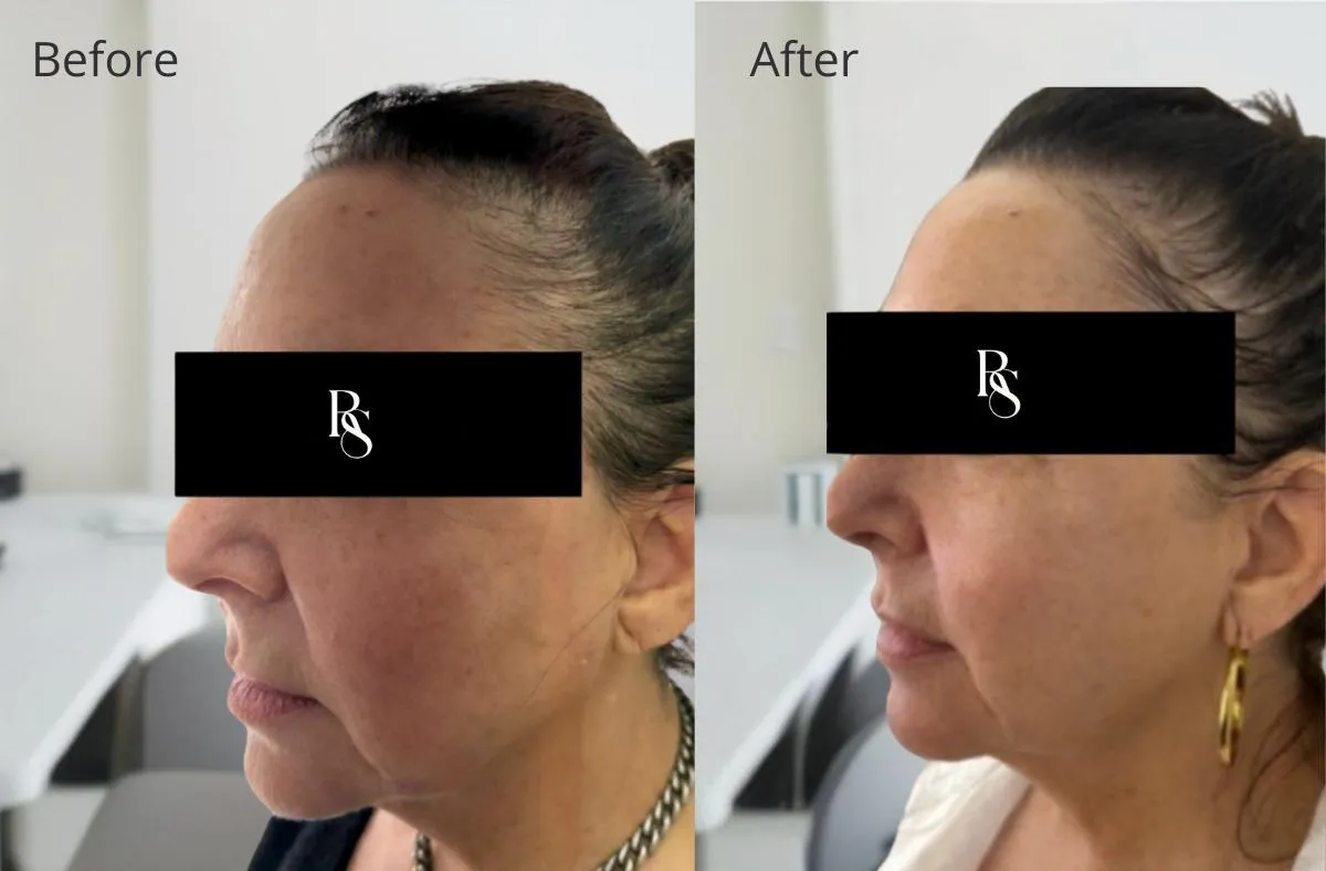 Radiant Secrets blog: Non Surgical Face Lift Johannesburg | Radiant Secrets