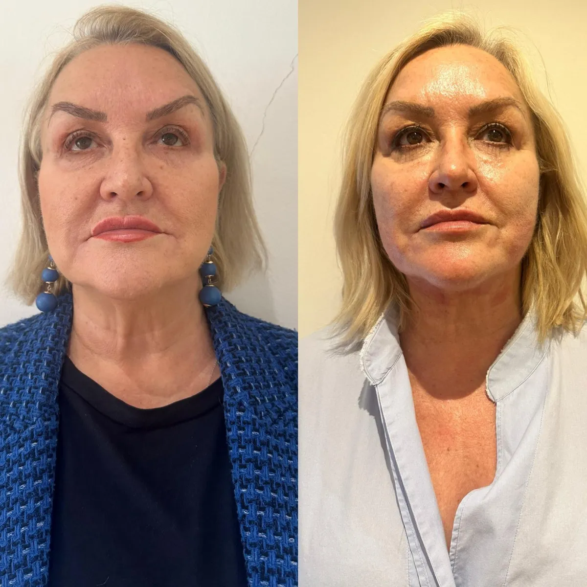 Client before and after result