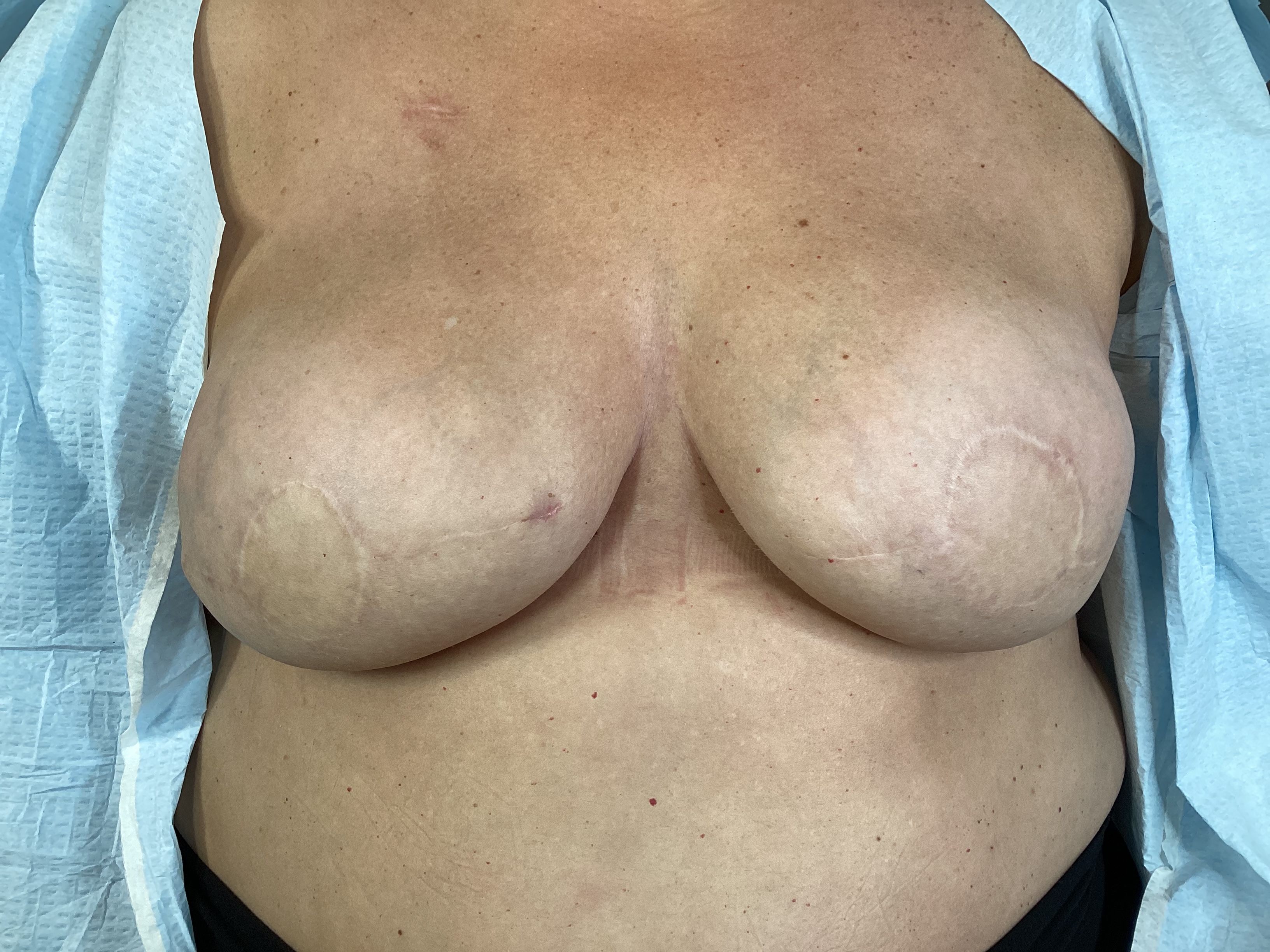 Before 3D Areola by Julie Michaud