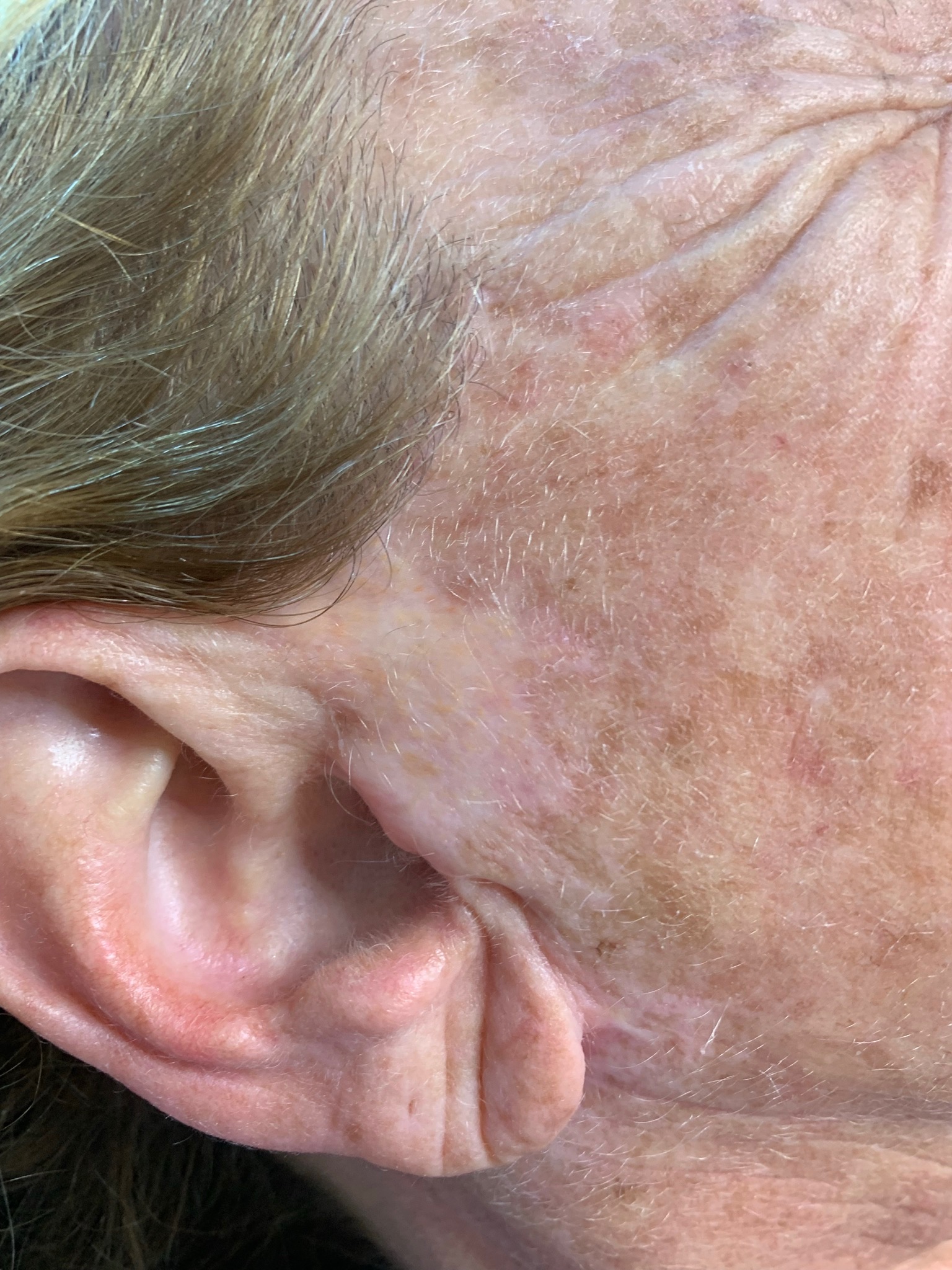 scar camouflage paramedical tattoo treatment Boston