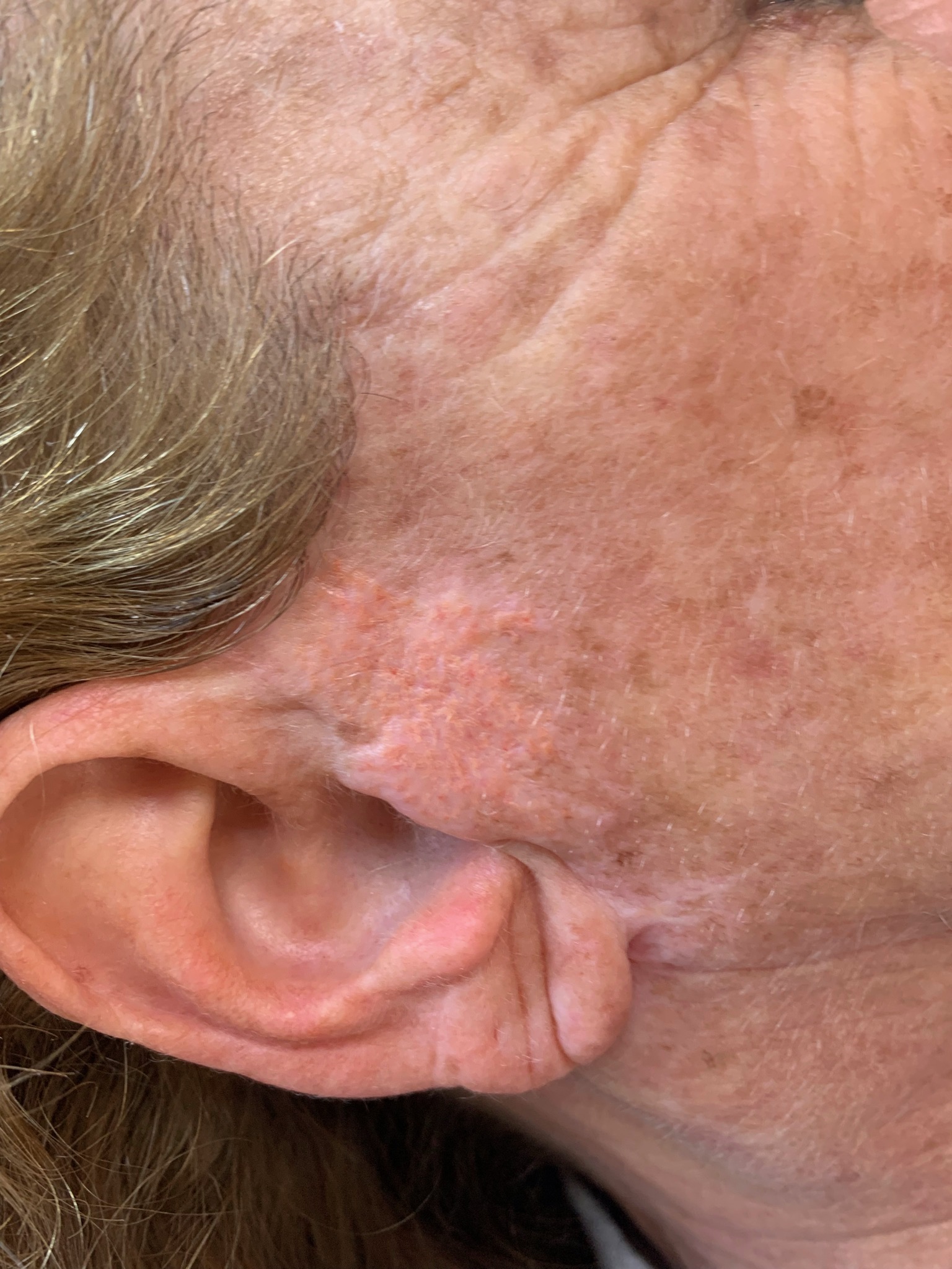 paramedical tattoo scar blending natural results