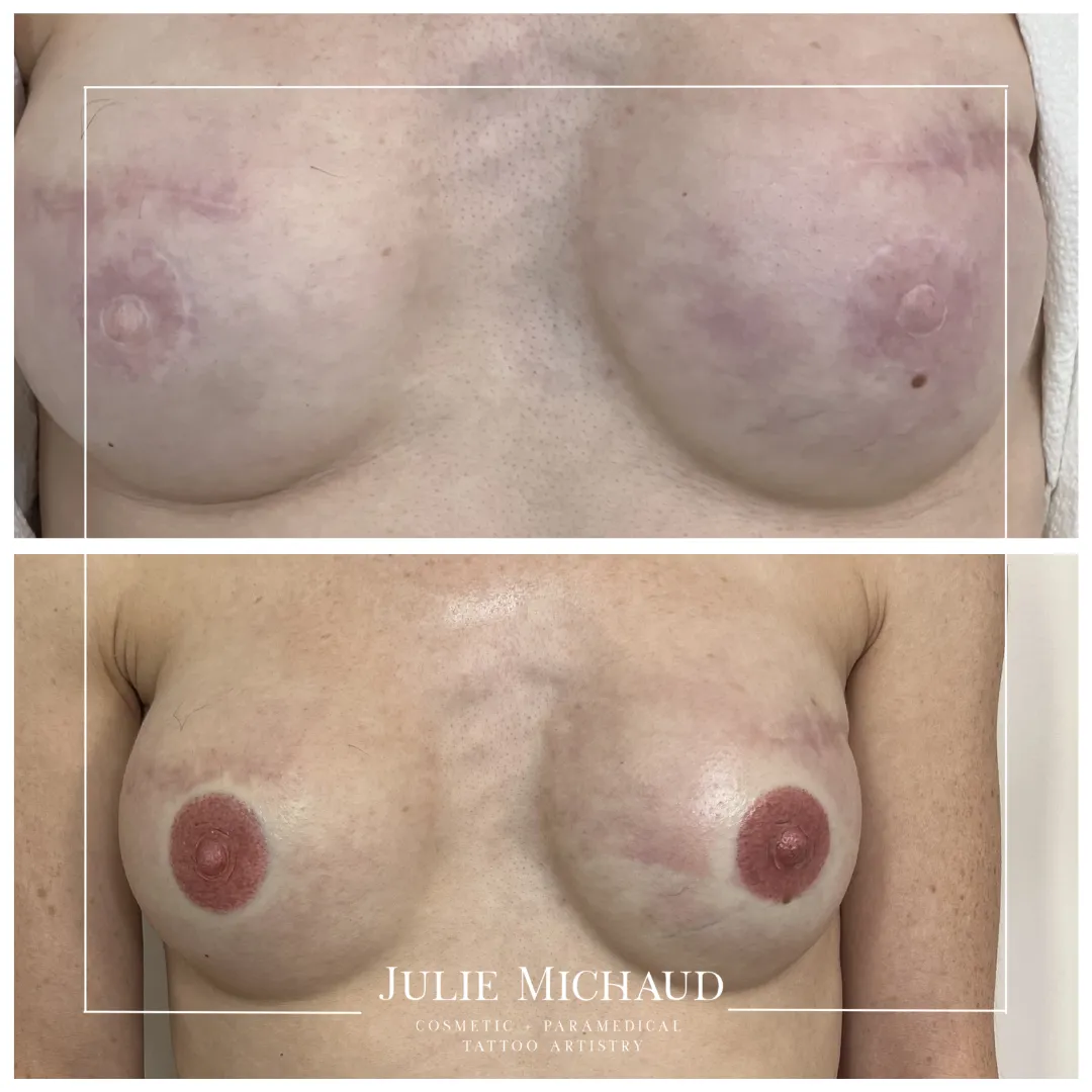 Before and after 3D areola medical tattooing showing realistic restoration with natural color and 3D dimension.