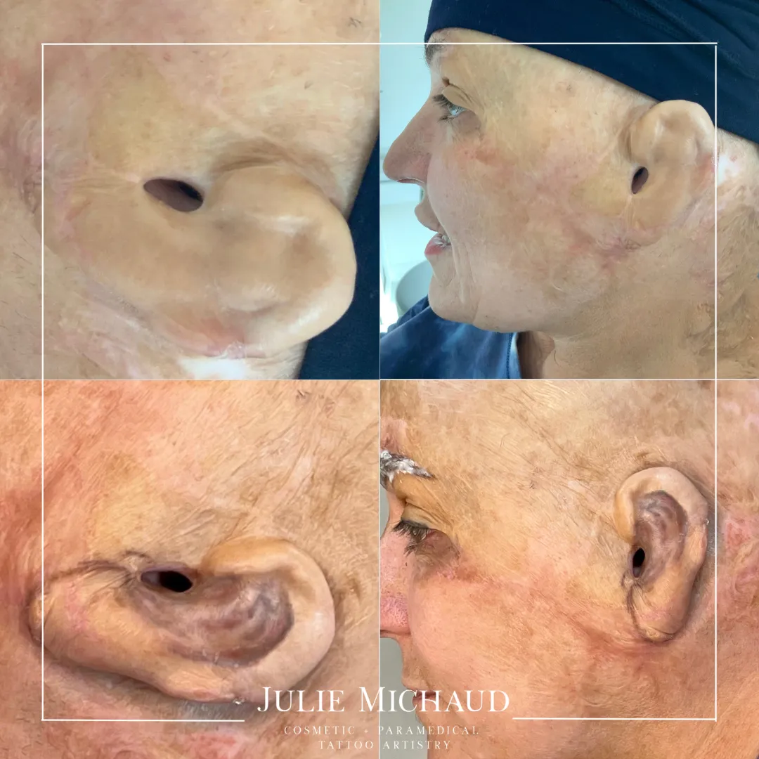 Before and after scar camouflage tattoo creating a natural-looking ear with blended skin tone and restored appearance.