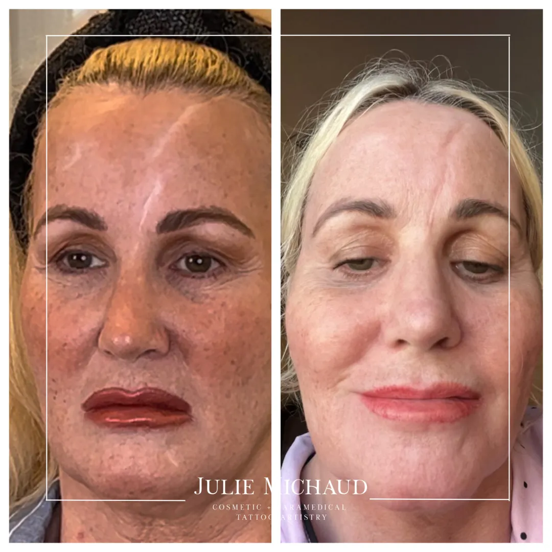 Before and after scar camouflage tattoo reducing visibility of scar with blended skin tone.