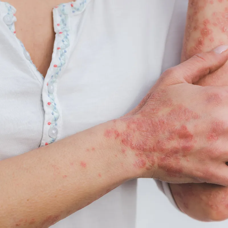 Autoimmune Conditions