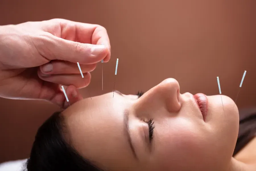 Acupuncture services in Vancouver, Surrey & Langley
