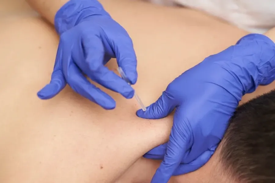 Intramuscular Stimulation