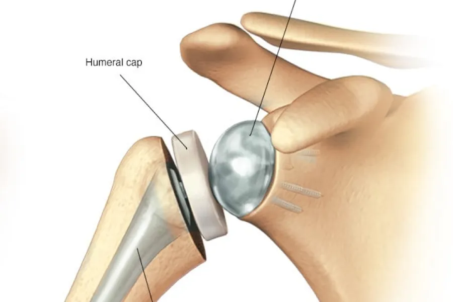 Comprehensive humera cal procedure, tailored to individual needs in Vancouver and nearby areas.