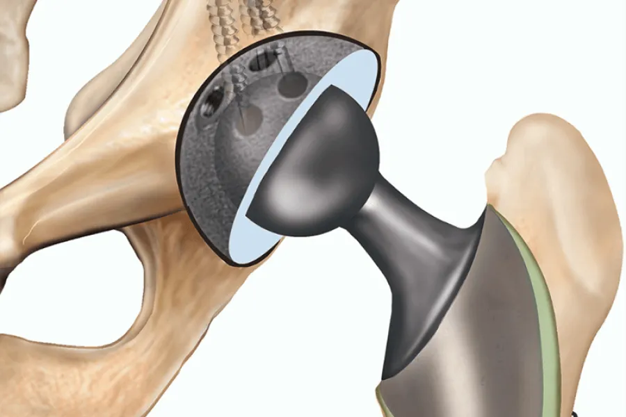 Total hip replacement at Prosper Health & Rehab in Vancouver and nearby areas.