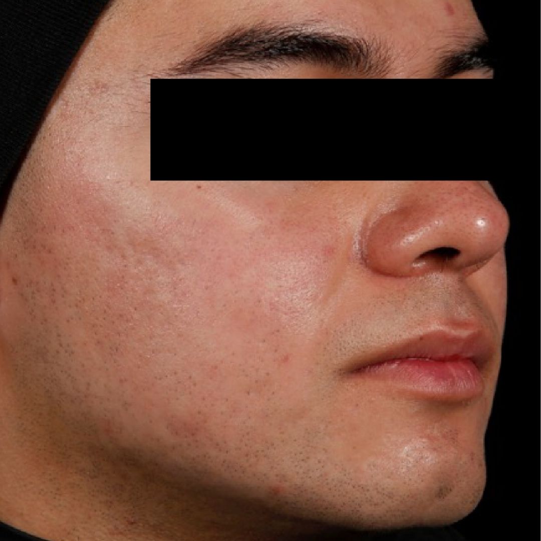 AviClear after frontal portrait