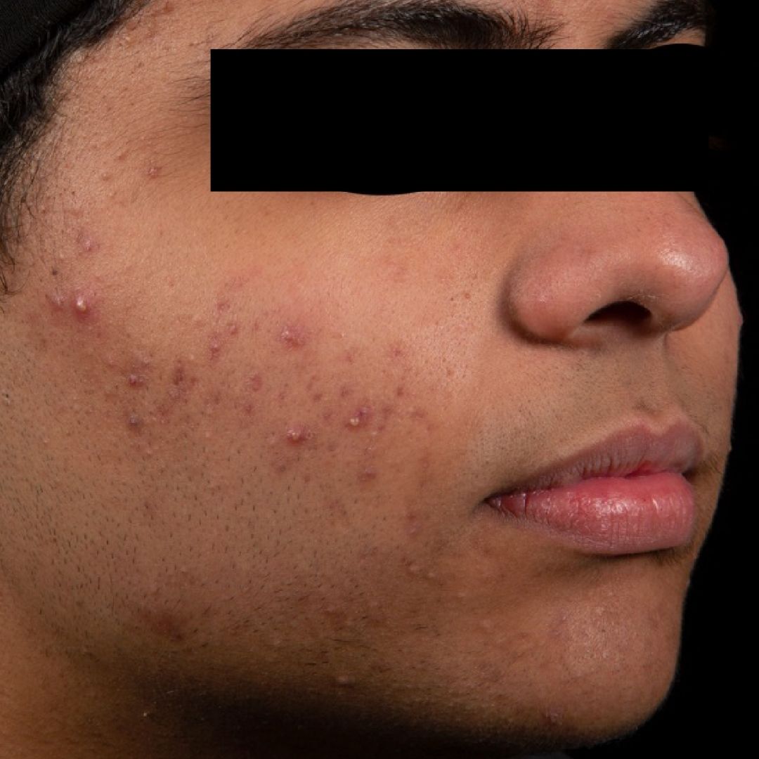 AviClear before side profile