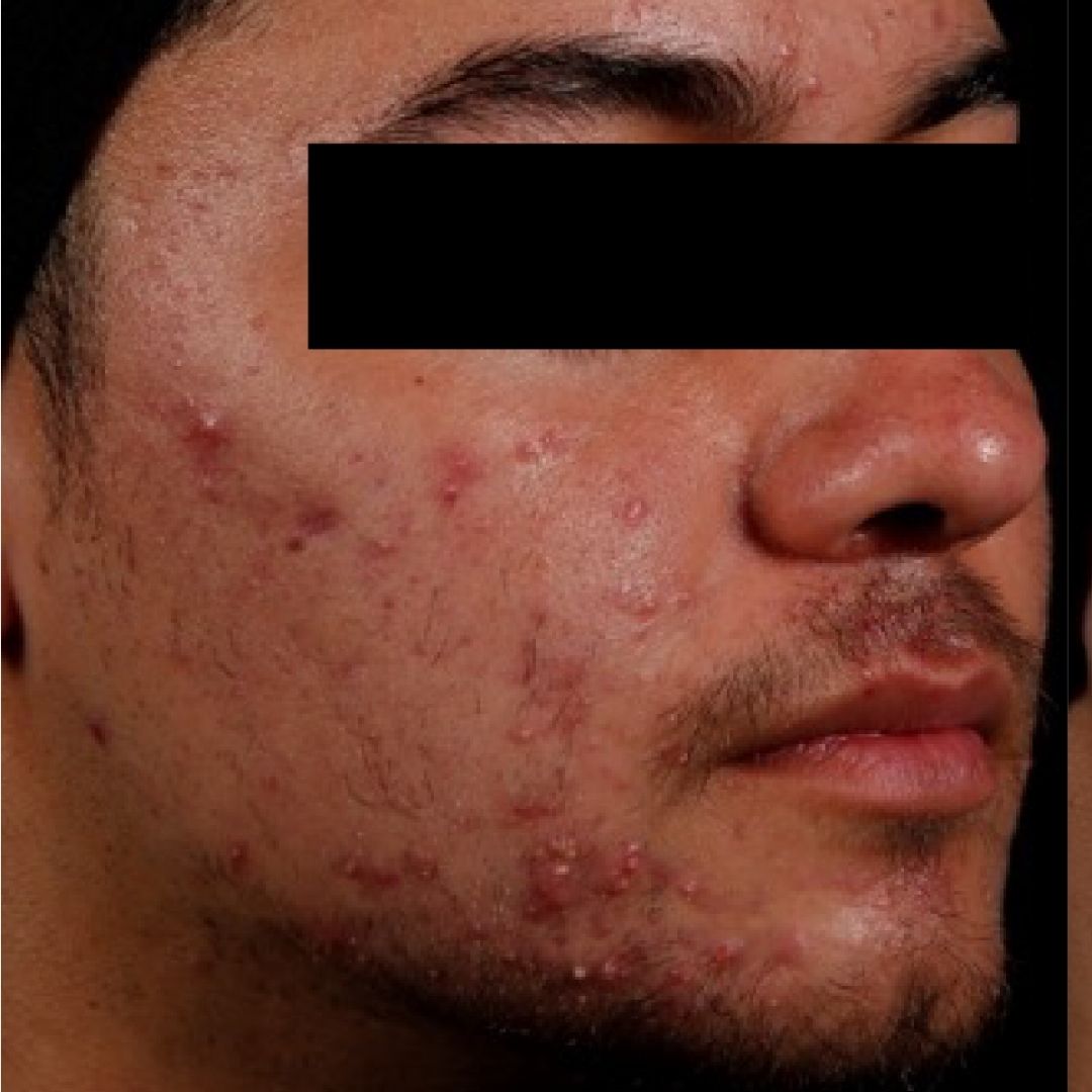 AviClear before frontal portrait