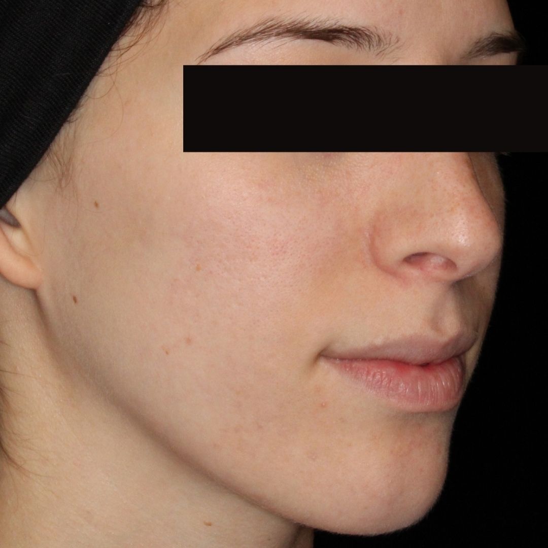 AviClear after teen acne