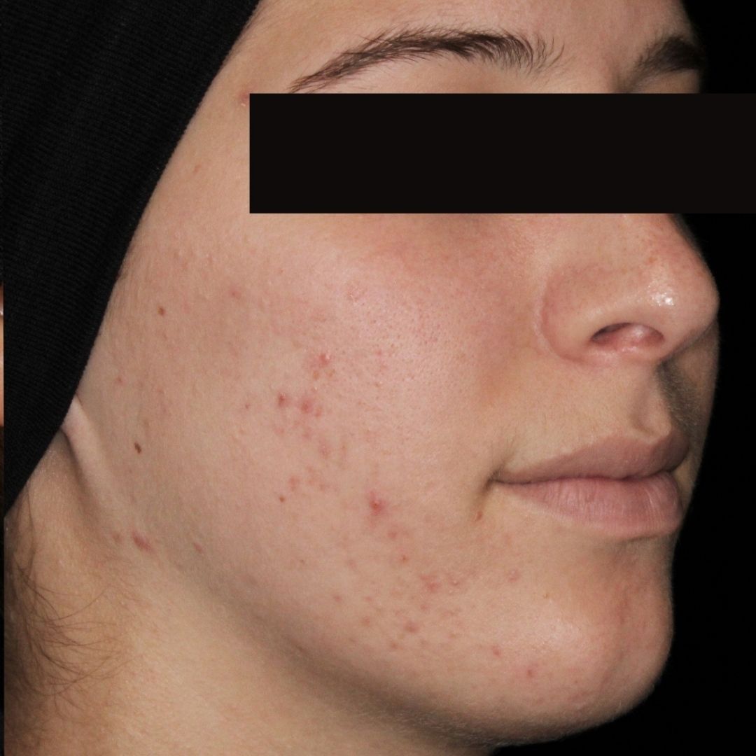 AviClear before teen acne