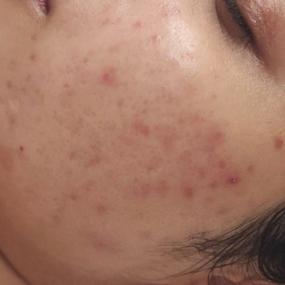 After AviClear acne treatment - placeholder