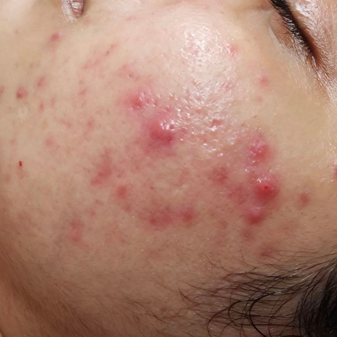 Before AviClear acne treatment - placeholder