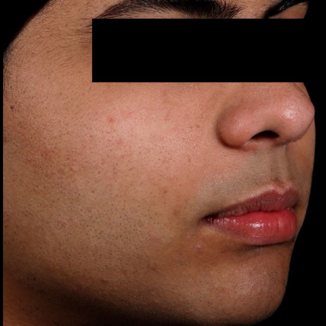 AviClear after side profile