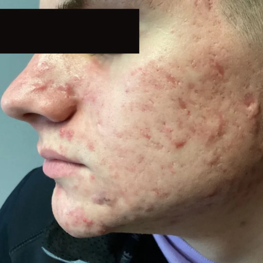 AviClear after jawline acne