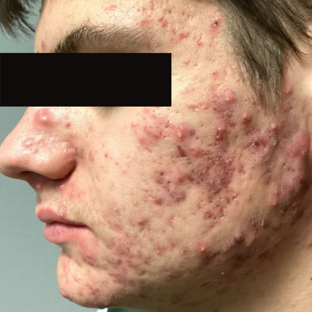 AviClear before jawline acne